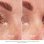 Dispositivo Facial Silk'n FaceTite Mini Blanco Radiofrecuencia RF LED Antiedad Integrado