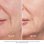 Dispositivo Reafirmante Facial Beurer FC100 HT Home Tightening sem fio, tecnologia RF e LED