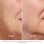 Dispositivo Reafirmante Facial Beurer FC100 HT Home Tightening sem fio, tecnologia RF e LED
