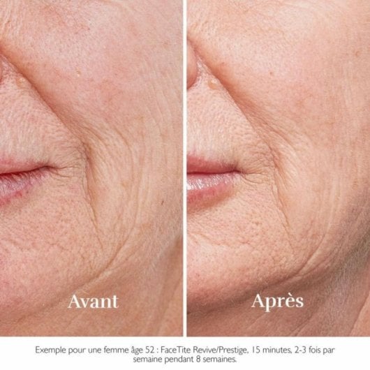 Dispositivo Reafirmante Facial Beurer FC100 HT Home Tightening sem fio, tecnologia RF e LED