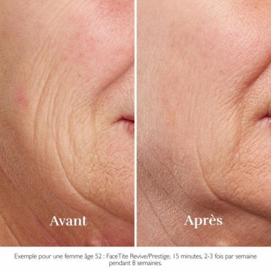 Dispositivo Reafirmante Facial Beurer FC100 HT Home Tightening sem fio, tecnologia RF e LED